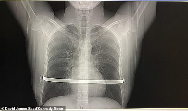 David had a curved metal bar placed underneath his sternum and attached to both sides of his rib cage with wire and pins to force the bones back into their correct position