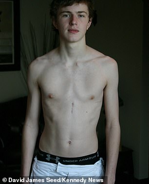 David, pictured after recovering from his chest surgery in 2006. He dreaded summer holidays as a youngster because of a deformity that meant his chest grew inwards, and was self-conscious about taking his top off
